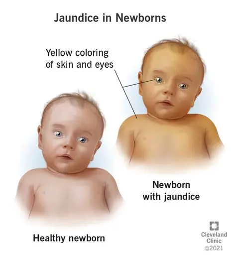 IJSON Bayi: A Comprehensive Guide to Infant Jaundice – Causes, Symptoms, and Treatment